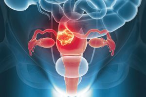 The secrecy and shame around women’s cancers