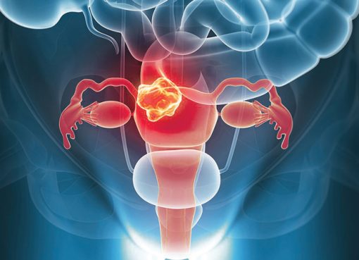 The secrecy and shame around women’s cancers