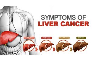 Liver Cancer can be prevented – by avoiding alcohol abuse, occurrence of Hepatitis B or Hepatitis C