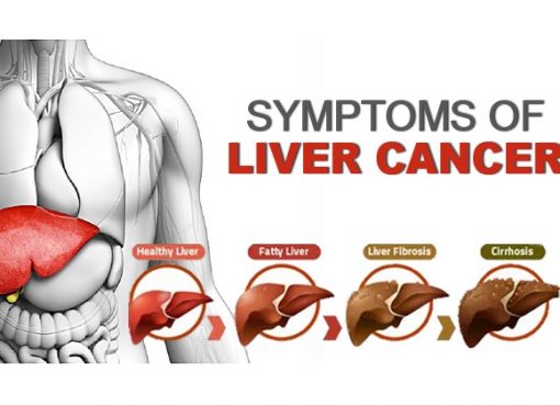 Liver Cancer can be prevented – by avoiding alcohol abuse, occurrence of Hepatitis B or Hepatitis C