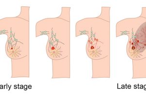 Small Changes in Life Style – Can Reduce the Risk of Breast Cancer