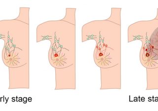 Small Changes in Life Style – Can Reduce the Risk of Breast Cancer