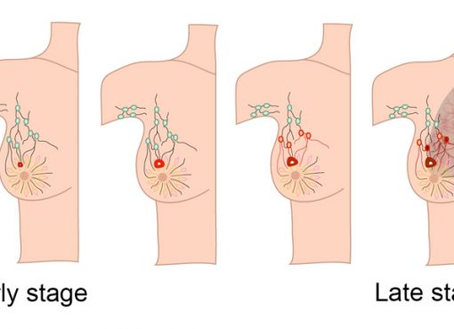 Small Changes in Life Style – Can Reduce the Risk of Breast Cancer