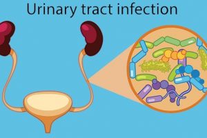 Urinary Tract Infections (UTIs) –  Women are more Vulnerable