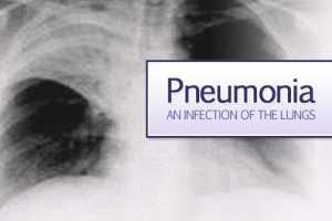 In this Pandemic Era, When world is battling with COVID  Early Detection of Pneumonia is Key to Save Lives