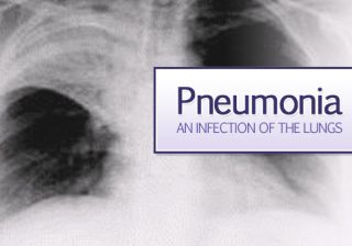 In this Pandemic Era, When world is battling with COVID  Early Detection of Pneumonia is Key to Save Lives