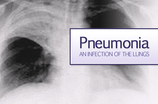 In this Pandemic Era, When world is battling with COVID  Early Detection of Pneumonia is Key to Save Lives