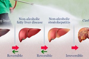 Increasing Obese and Diabetic, India’s immediate concern is Fatty Liver Disease