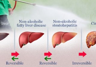Increasing Obese and Diabetic, India’s immediate concern is Fatty Liver Disease
