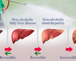 Increasing Obese and Diabetic, India’s immediate concern is Fatty Liver Disease