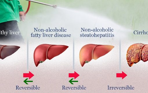 Increasing Obese and Diabetic, India’s immediate concern is Fatty Liver Disease