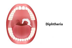 Study warns Diphtheria could become a major global threat