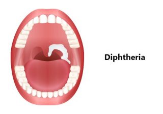 Study warns Diphtheria could become a major global threat