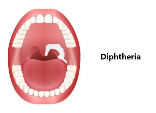 Study warns Diphtheria could become a major global threat
