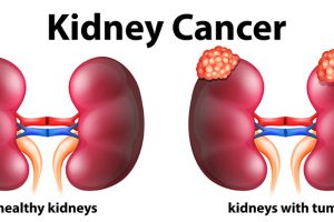 ESSENTIAL NUTRITION; ‘DOS AND DON’TS’ FOR PEOPLE WITH KIDNEY CANCER