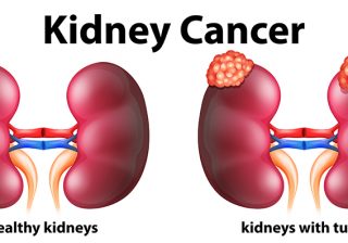 ESSENTIAL NUTRITION; ‘DOS AND DON’TS’ FOR PEOPLE WITH KIDNEY CANCER