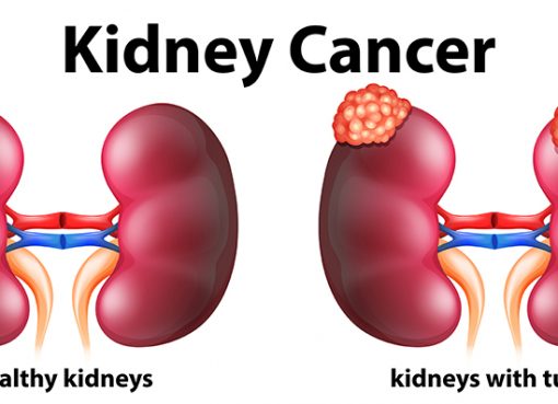 ESSENTIAL NUTRITION; ‘DOS AND DON’TS’ FOR PEOPLE WITH KIDNEY CANCER