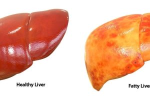 Researchers reveal how excess sugar causes fatty liver