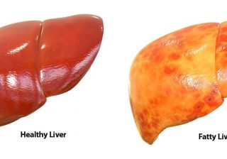 Researchers reveal how excess sugar causes fatty liver