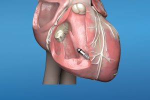 MEDTRONIC LAUNCHES MICRA™ AV, WORLD’S SMALLEST PACEMAKER WITH ATRIOVENTRICULAR (AV) SYNCHRONYTO TREAT HEART BLOCK IN PATIENTS IN INDIA