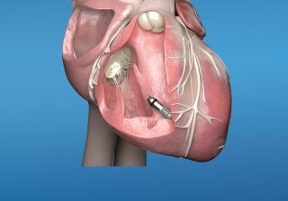 MEDTRONIC LAUNCHES MICRA™ AV, WORLD’S SMALLEST PACEMAKER WITH ATRIOVENTRICULAR (AV) SYNCHRONYTO TREAT HEART BLOCK IN PATIENTS IN INDIA
