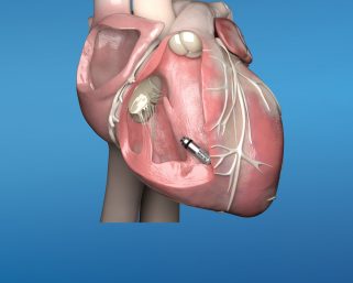 MEDTRONIC LAUNCHES MICRA™ AV, WORLD’S SMALLEST PACEMAKER WITH ATRIOVENTRICULAR (AV) SYNCHRONYTO TREAT HEART BLOCK IN PATIENTS IN INDIA