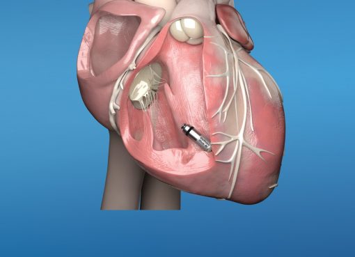 MEDTRONIC LAUNCHES MICRA™ AV, WORLD’S SMALLEST PACEMAKER WITH ATRIOVENTRICULAR (AV) SYNCHRONYTO TREAT HEART BLOCK IN PATIENTS IN INDIA