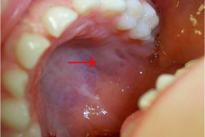 mouth cancer was successfully operated at Omega Century by Dr K Benod Kumar in Hyderabad