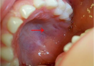 mouth cancer was successfully operated at Omega Century by Dr K Benod Kumar in Hyderabad