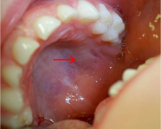 mouth cancer was successfully operated at Omega Century by Dr K Benod Kumar in Hyderabad