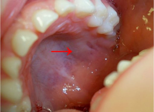 mouth cancer was successfully operated at Omega Century by Dr K Benod Kumar in Hyderabad