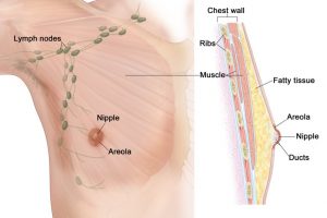 A 70 years old man with stage 1 breast cancer was successfully treated at Wockhardt hospitals Mira Road