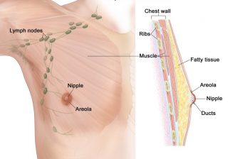 A 70 years old man with stage 1 breast cancer was successfully treated at Wockhardt hospitals Mira Road