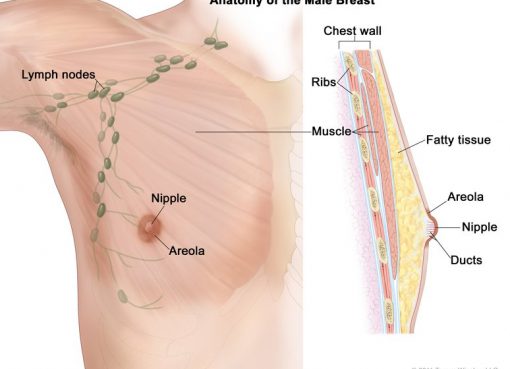 A 70 years old man with stage 1 breast cancer was successfully treated at Wockhardt hospitals Mira Road