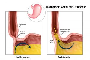 A Surge in Gastric Problems Bloating, Gas, Acidity and Indigestion During the Moist Months: Caution Doctors