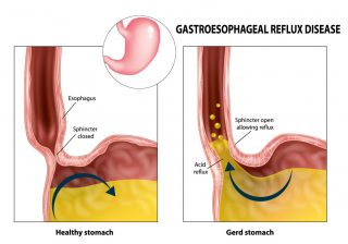 A Surge in Gastric Problems Bloating, Gas, Acidity and Indigestion During the Moist Months: Caution Doctors