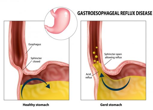 A Surge in Gastric Problems Bloating, Gas, Acidity and Indigestion During the Moist Months: Caution Doctors