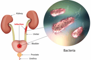 Urinary Tract Infections Surging In Summer Among Adults Aged 35-50