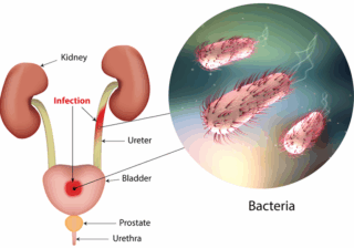 Urinary Tract Infections Surging In Summer Among Adults Aged 35-50