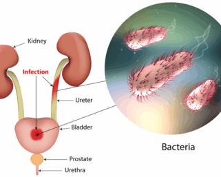 Urinary Tract Infections Surging In Summer Among Adults Aged 35-50