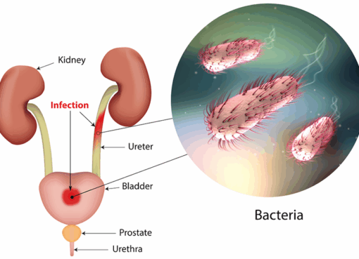 Urinary Tract Infections Surging In Summer Among Adults Aged 35-50