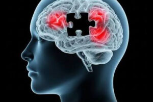 Alzheimer’s trial to test treatment before symptoms appear