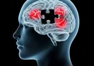 Alzheimer’s trial to test treatment before symptoms appear