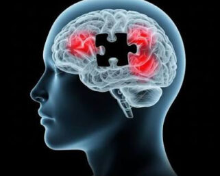 Alzheimer’s trial to test treatment before symptoms appear